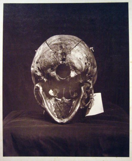 L'Affaire Peltzer: Skull as evidence, 1882