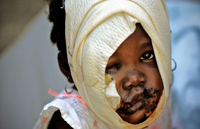 'Tiny victim' The battered and bandaged face of a child bears witness to the severity of the wounds seen at General Hospital in Port-au-Prince. The overwhelmed facility was deluged with patients seeking care. 'It's worse than I thought it would be,' one relief worker said. 'Most countries have some capacity to deal with emergencies; this one has no capacity to deal with emergencies.' (Nikki Kahn, The Washington Post - January 15, 2010)