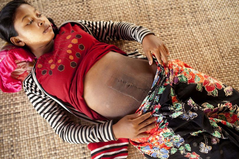 Four days after delivering her first child via Caesarian section, Bun still feels very weak. The stitches on her abdomen area were removed hours ago, but the scar seems set to last a lifetime. Her child is having a difficult time in the ICU as well © Bernice Wong